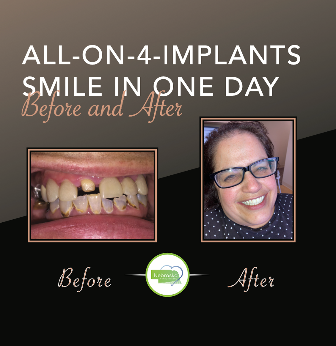 cosmetic-dentist-in-Lincoln,-NE-before-and-after-all-on-4-implants-smile-in-one-day