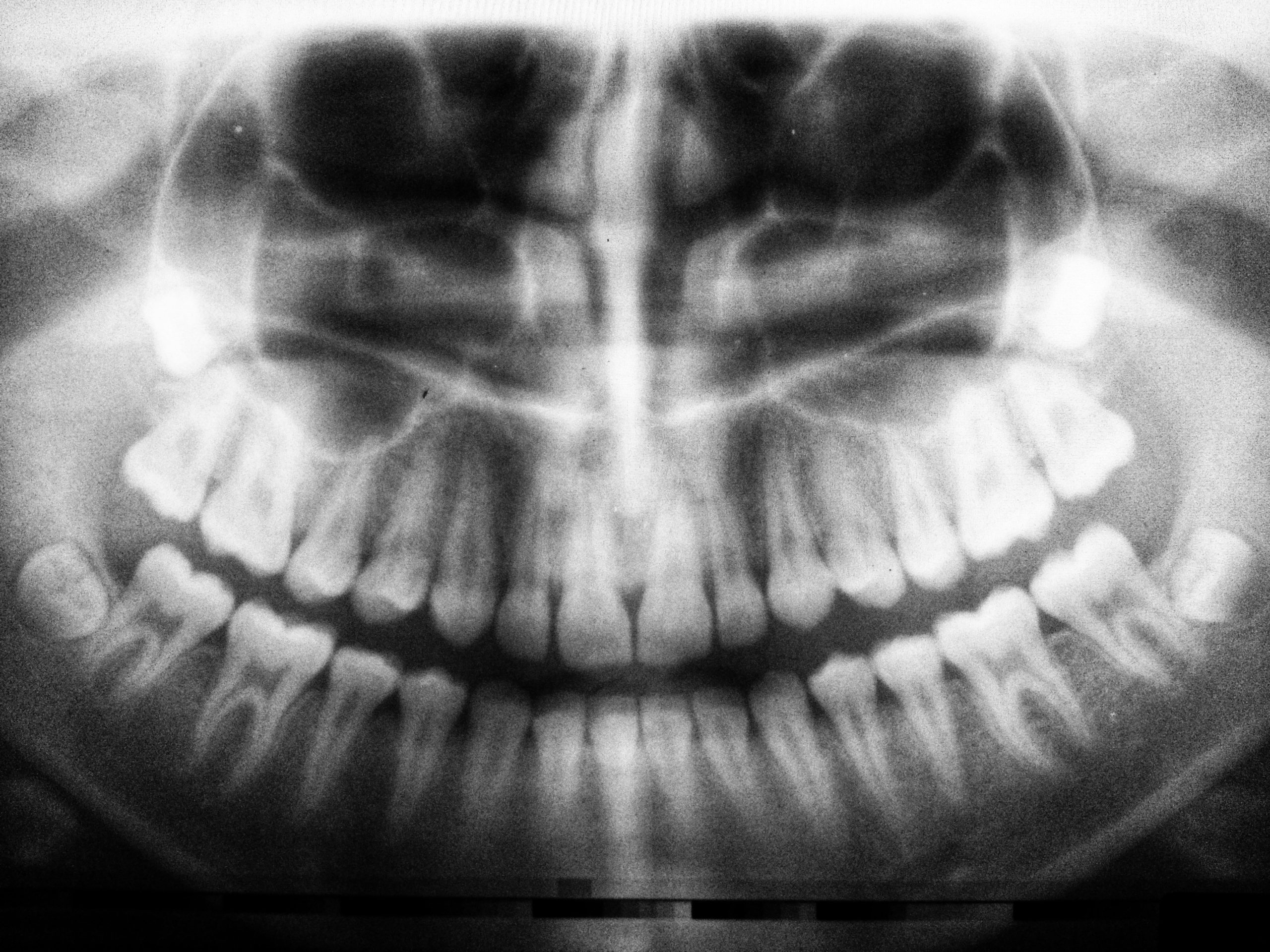 A full mouth x-ray. If you are experiencing a dental emergency in Lincoln, NE, call our dentists at Nebraska Family Dentistry.