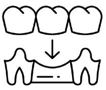 A dental bridge. Dental bridges "bridge" the gap left by a missing teeth or tooth and are a viable option when surrounding teeth are healthy.